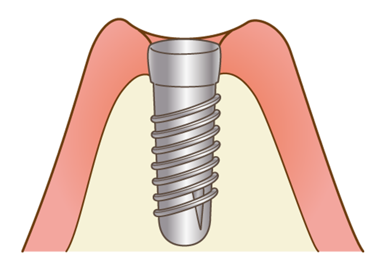 インプラント埋入（一次手術）