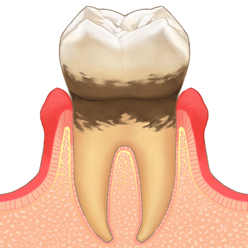 歯周病の原因は？